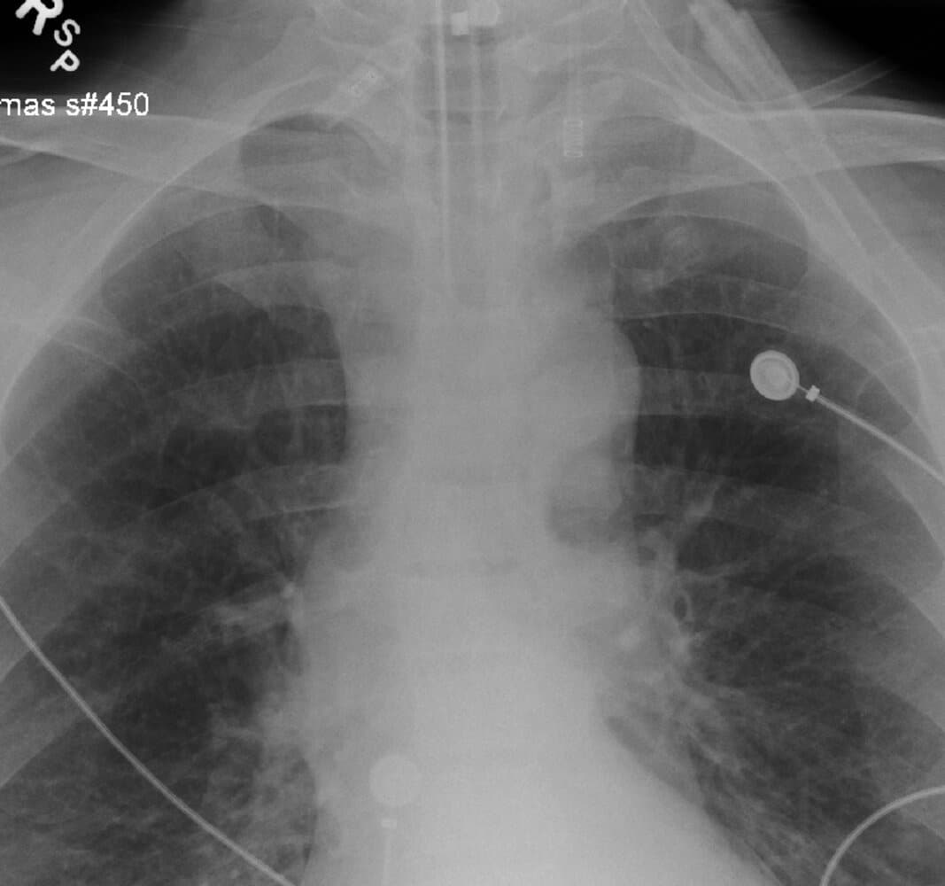 X-Ray View ET Tube Above Carina X-ray view of ET tube placed above carina.