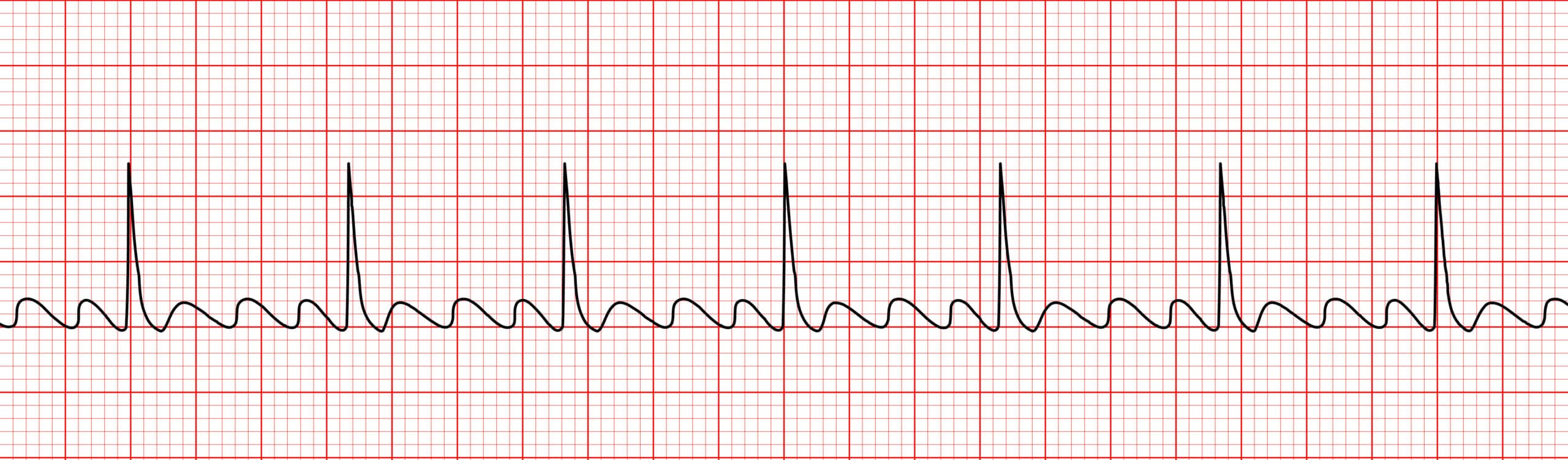 Atrial flutter ECG strip interpretation.