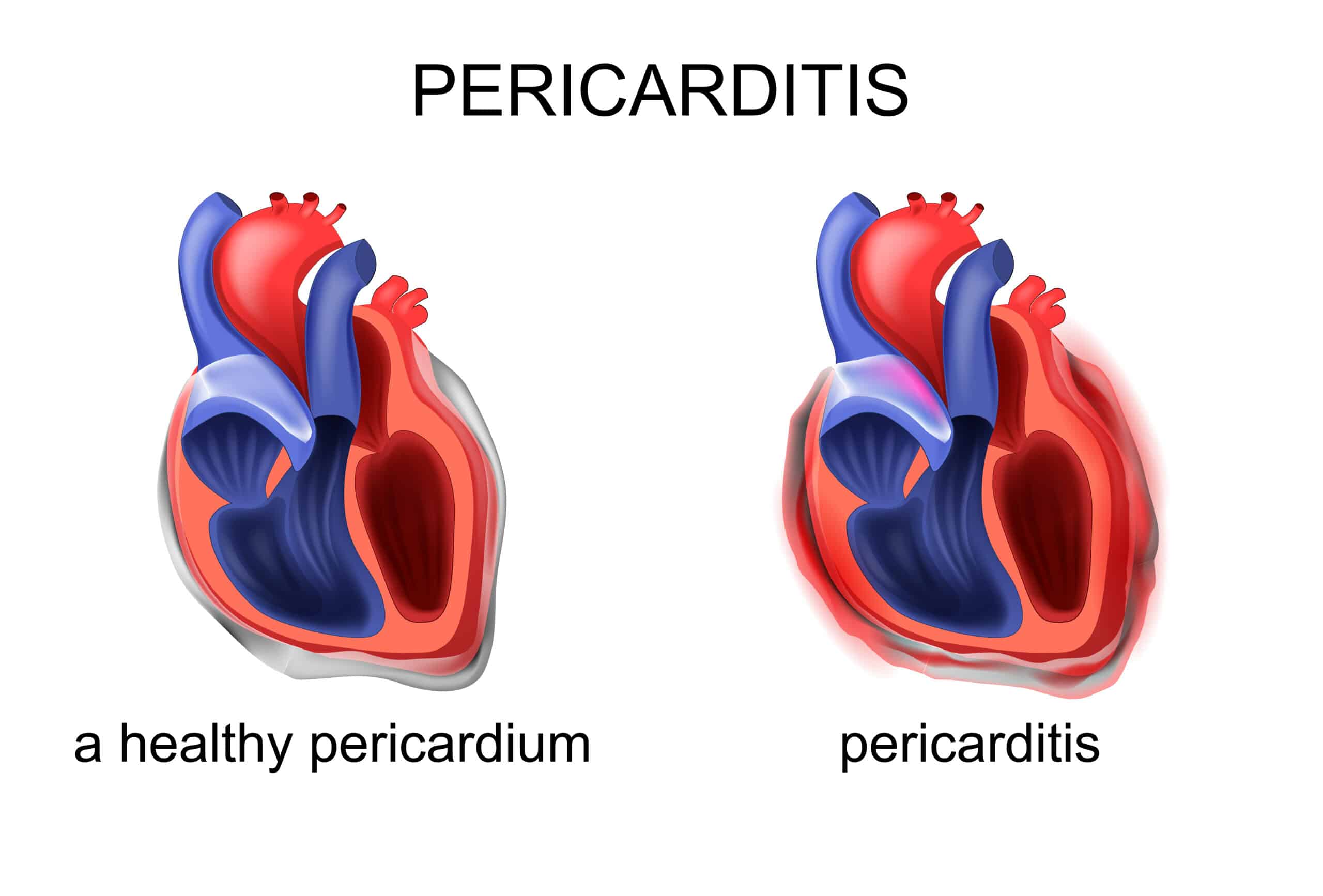 Pericarditis Illustration Pericarditis illustration.