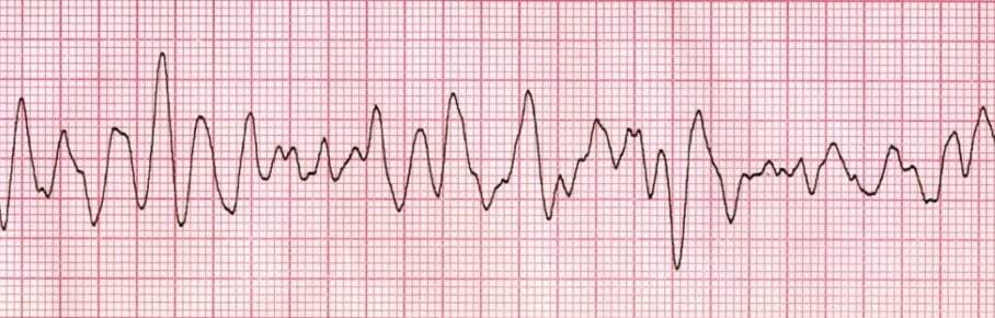 “Ventricular fibrillation is shockable rhythm.”