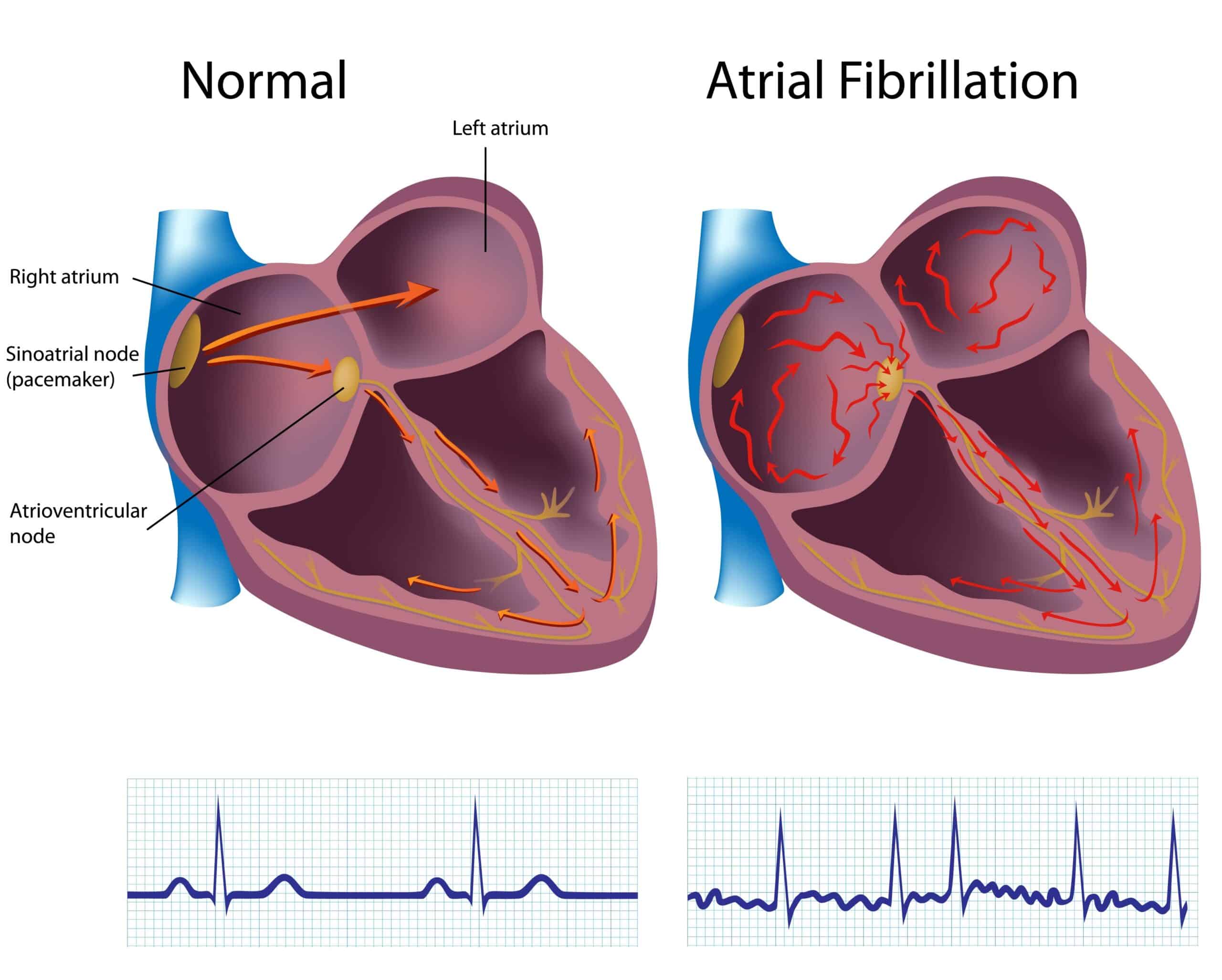 Atrial fibrillation - heart diagram and ECG tracing.