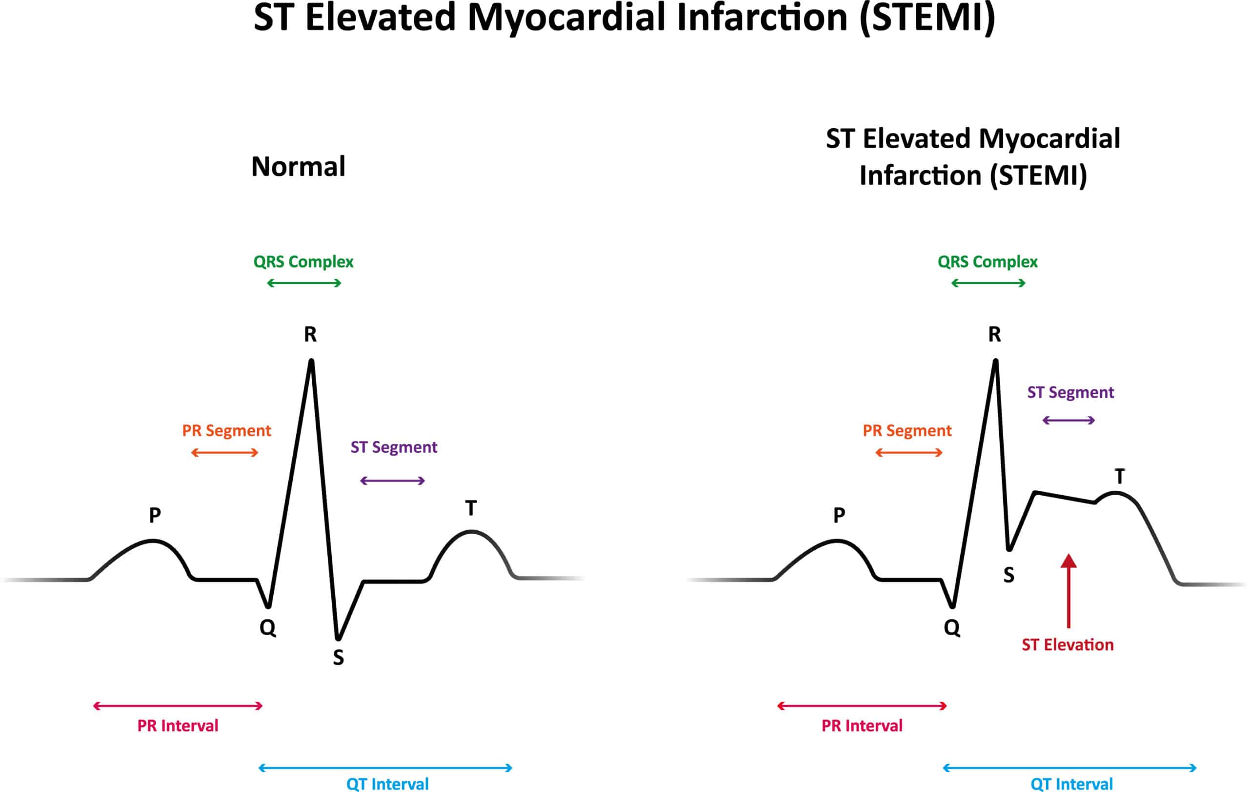 ST Elevated myocardial infarction (STEMI) ECG tracing.