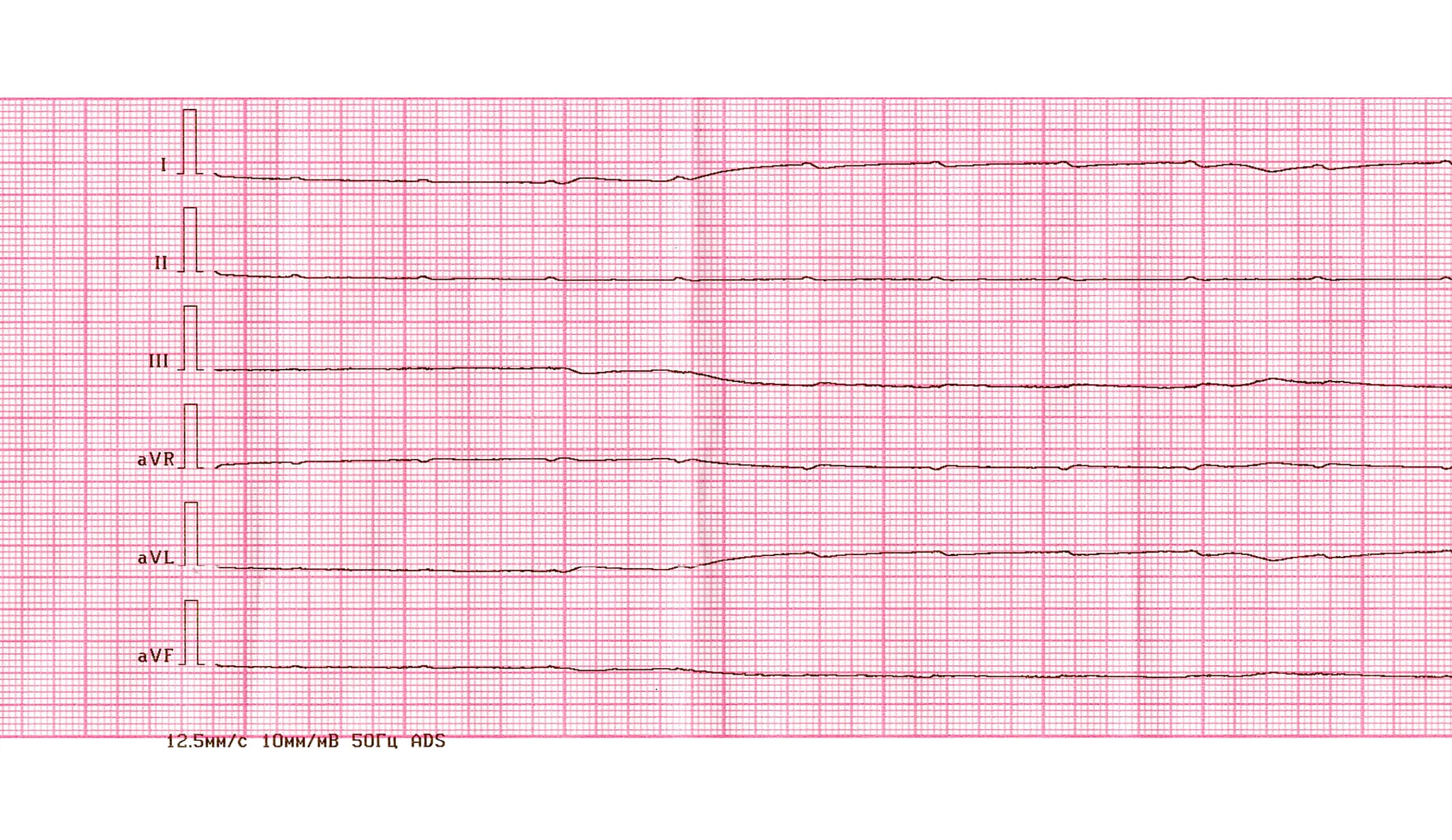 Asystole presents as a flatline on the EKG tracing.