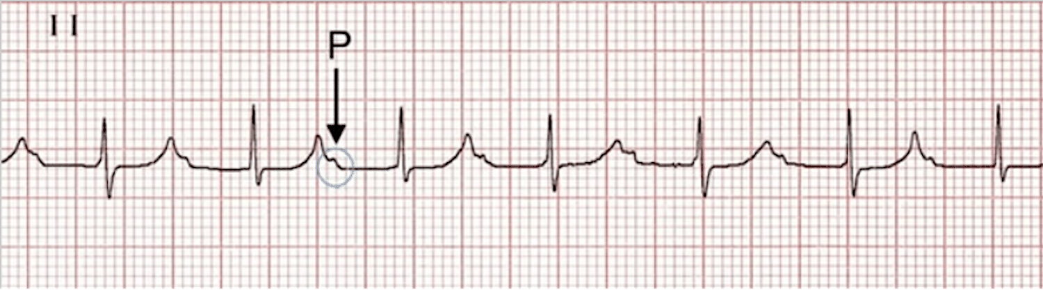First-degree AV block - ECG tracing.