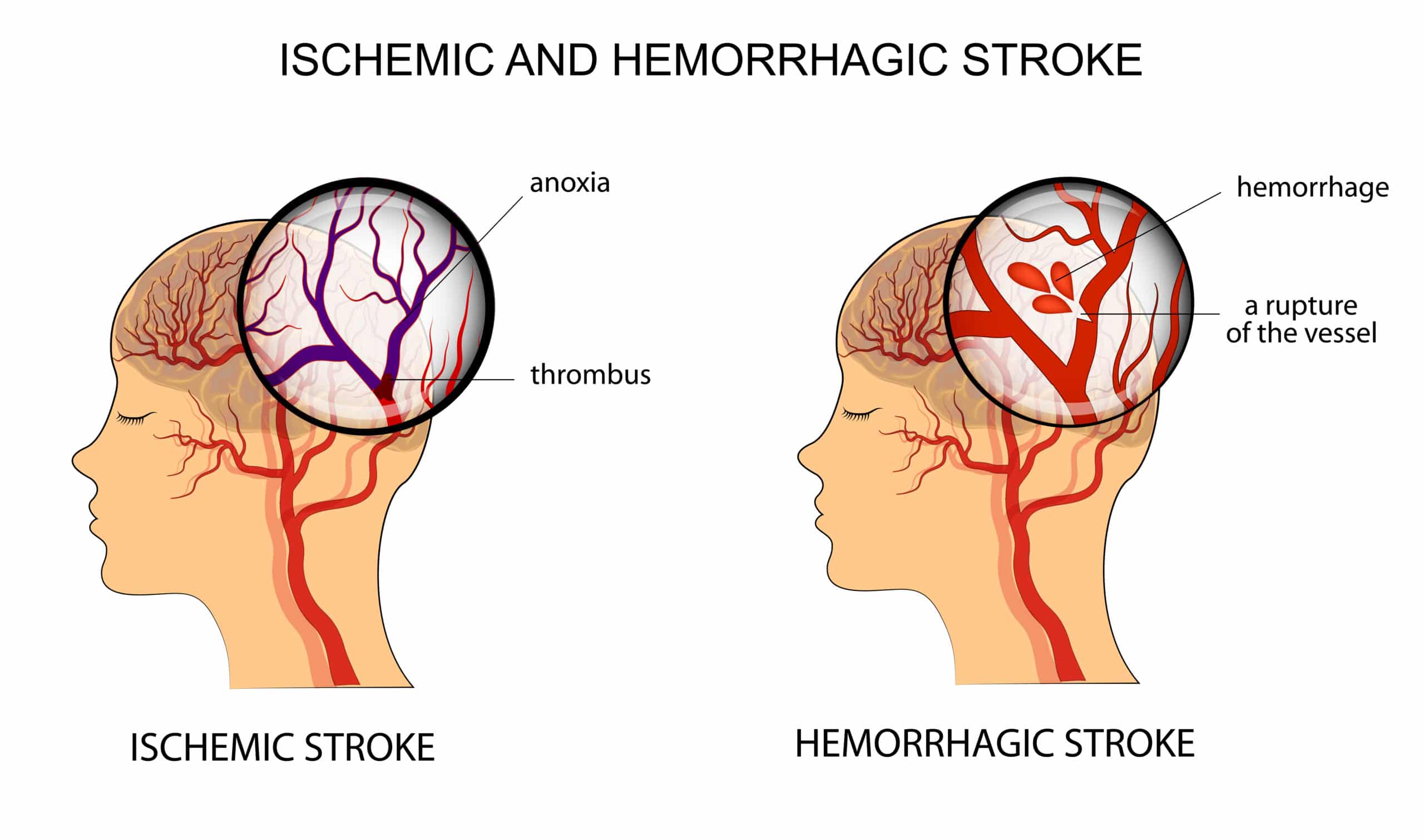 Stroke: Assessment in the Emergency Department