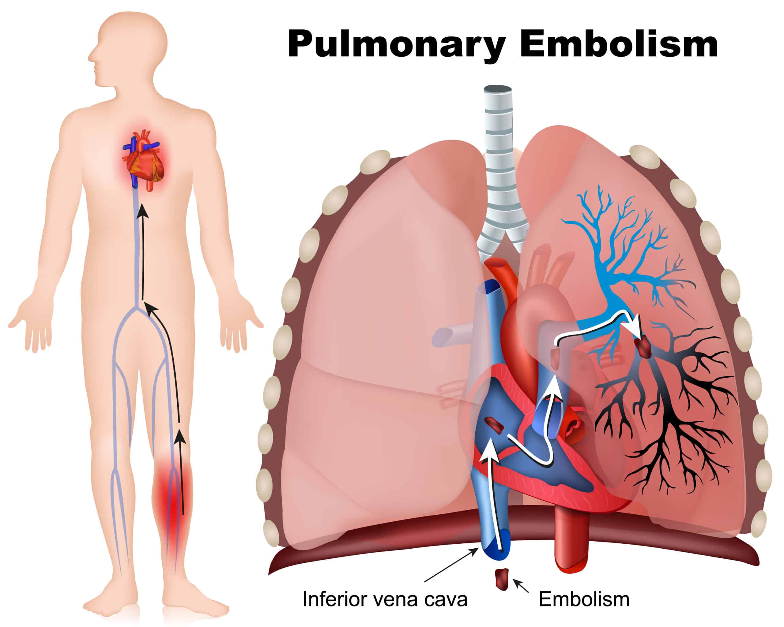 Pulmonary embolism - Diagram of the human body, heart, and lungs.