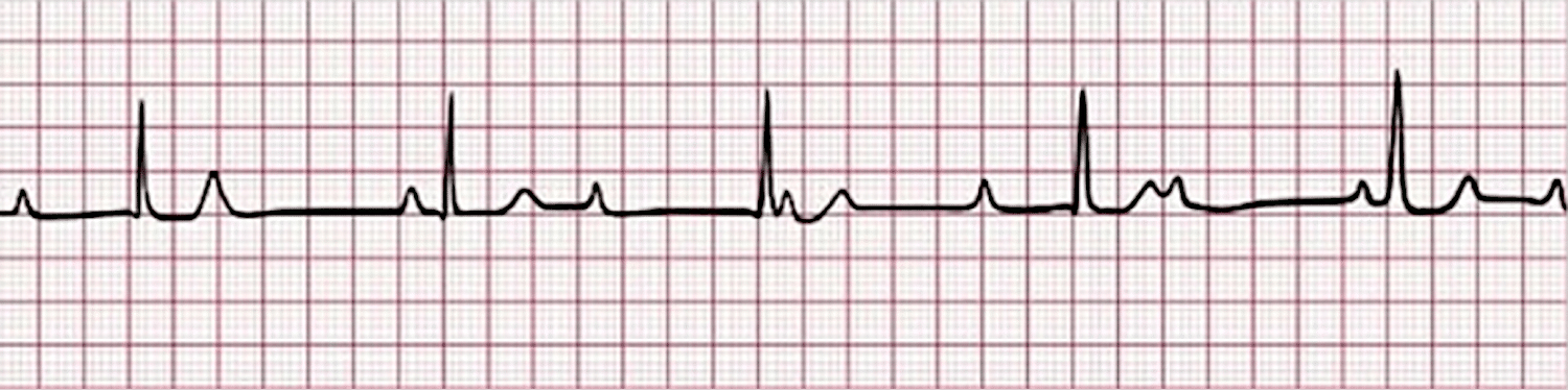 Third-degree AV block - ECG tracing.