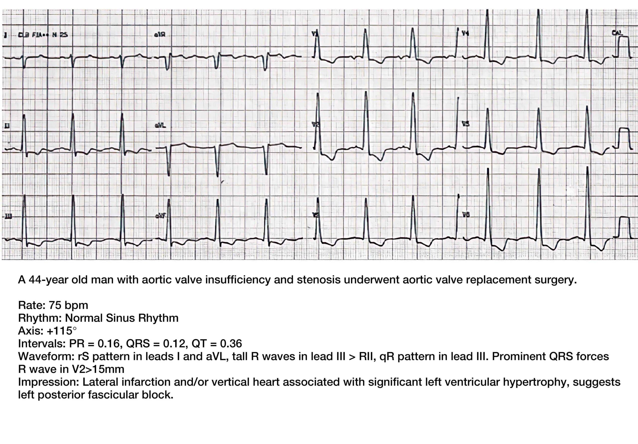 44-year-old man with aortic valve insufficiency and stenosis ECG.