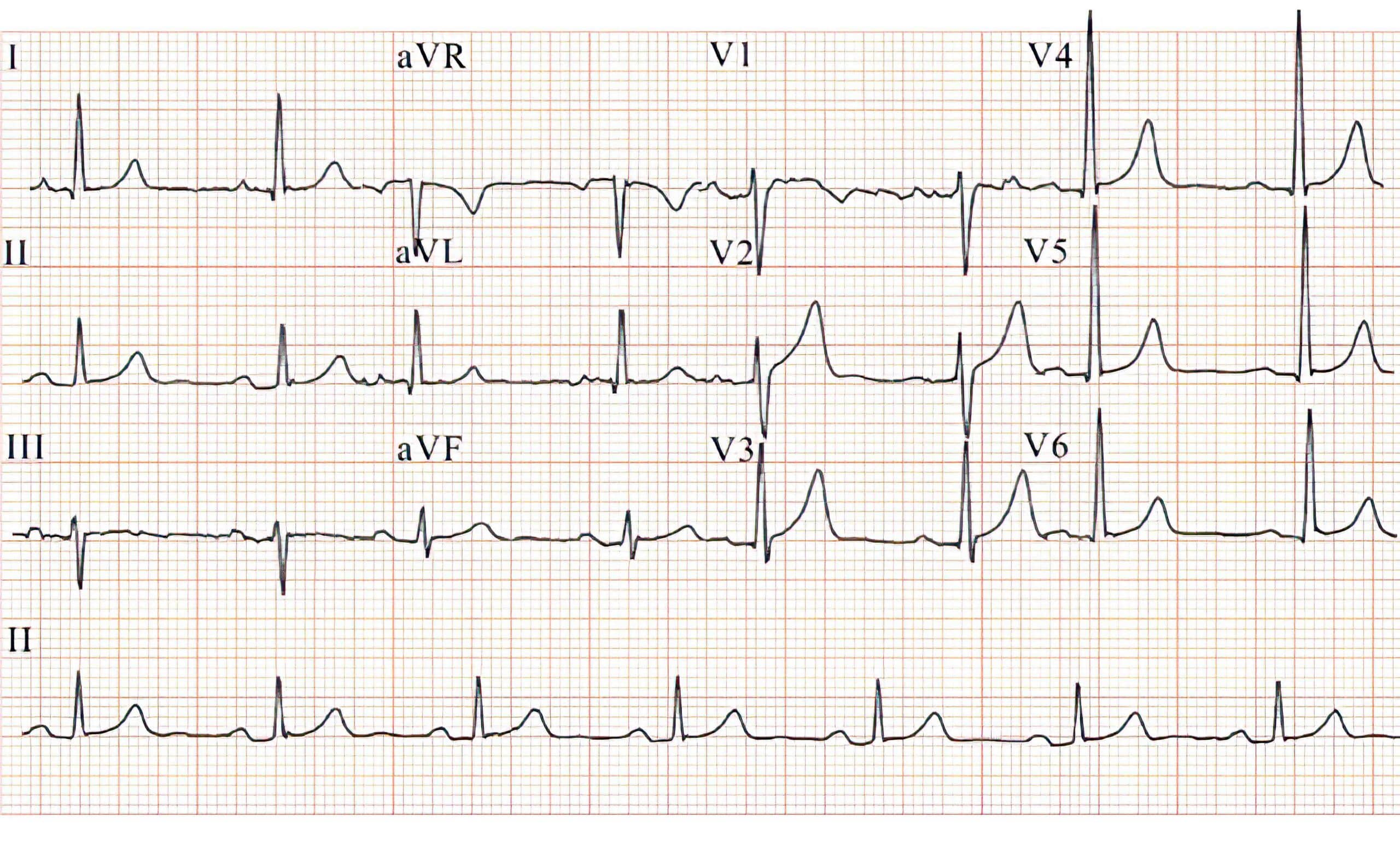 7-year-old boy with first-degree AV block ECG.