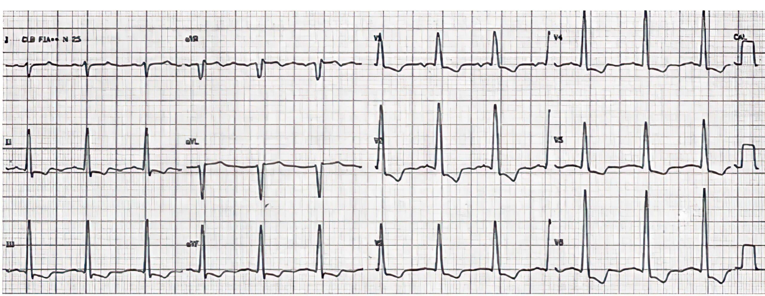 Case 2 three ECG rhythms.