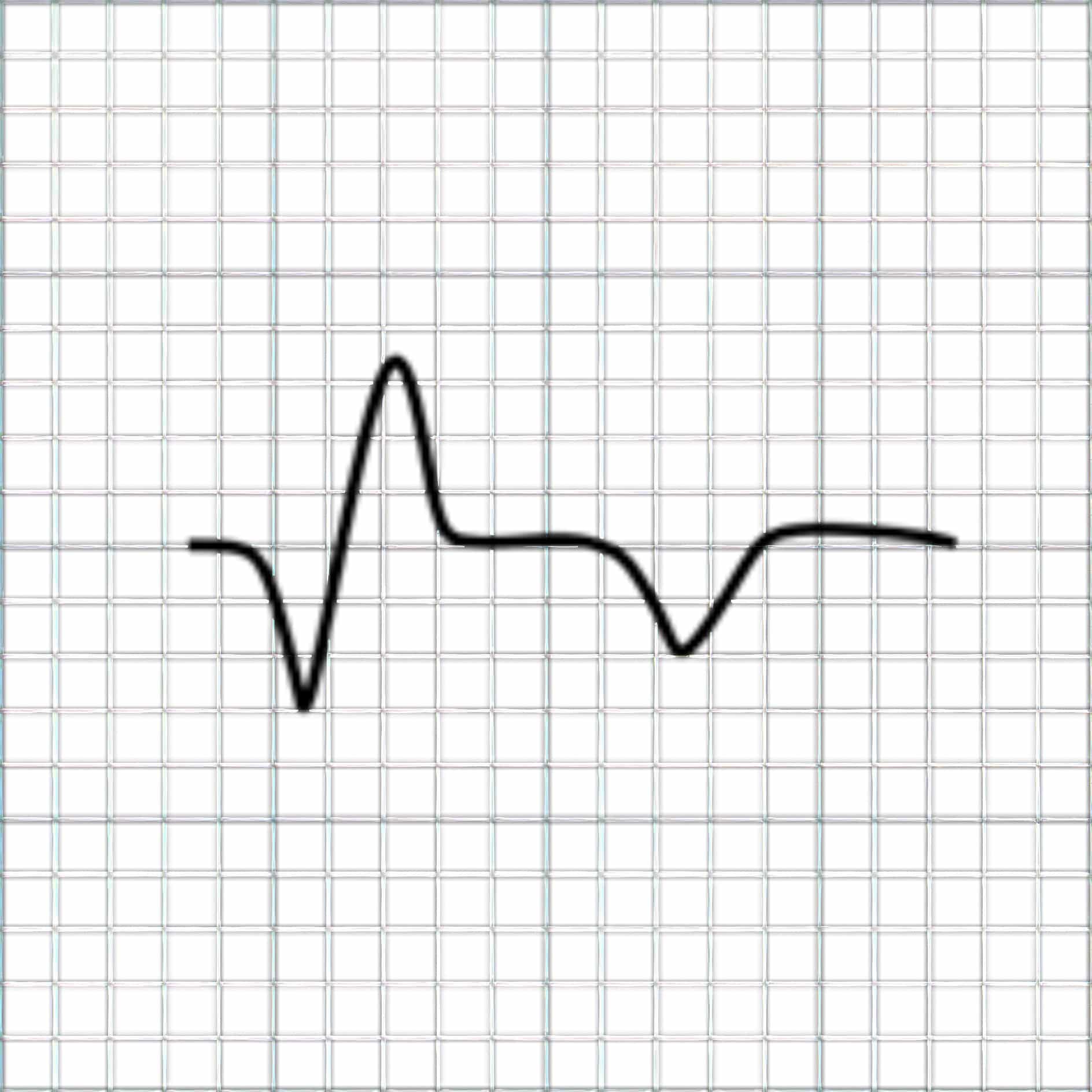 Chronic MI depicted by broad Q wave ECG.
