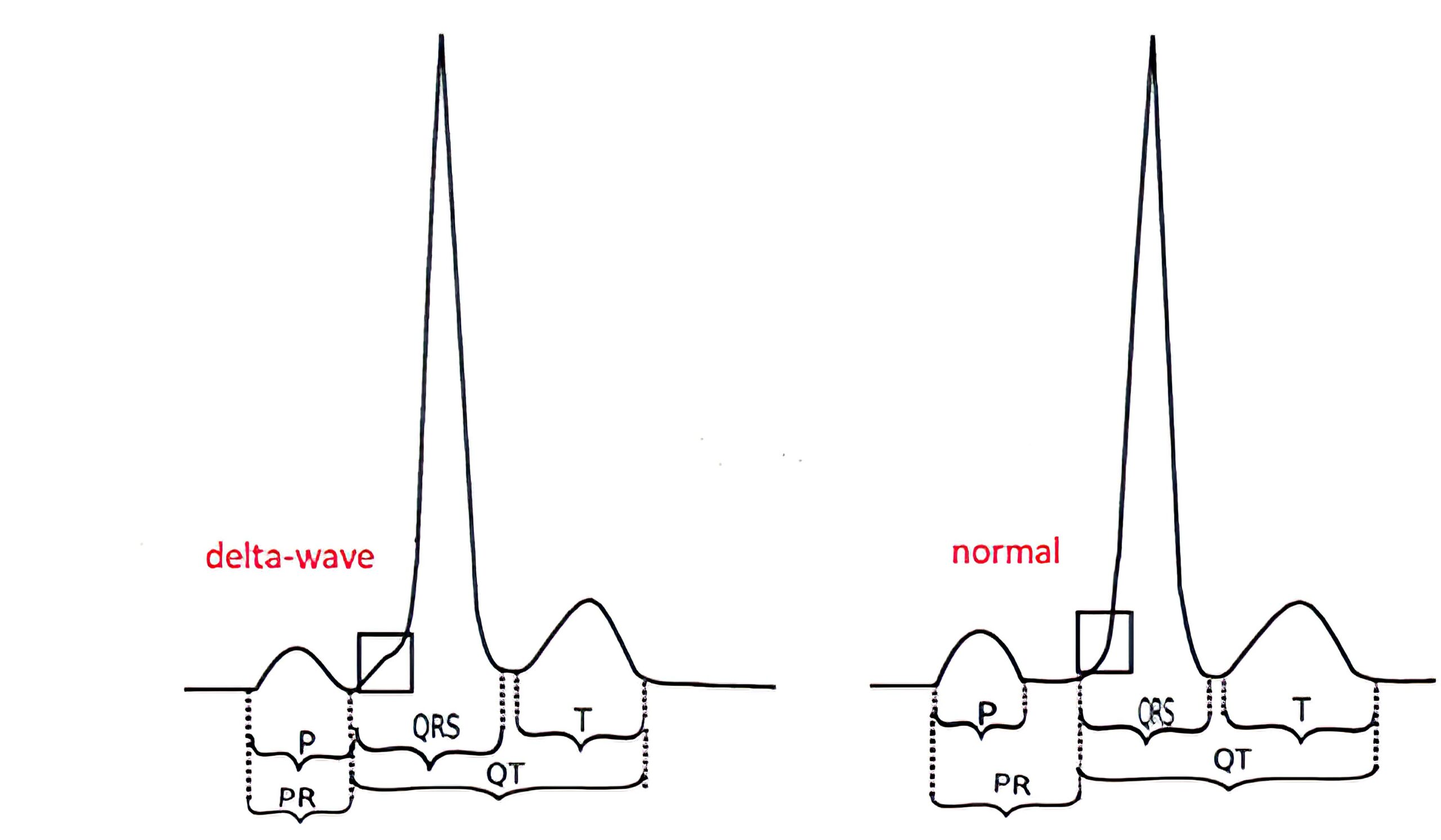 Delta wave morphology ECG.
