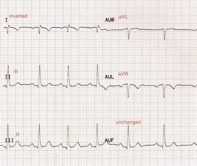 One ECG with correct limb lead placement and one interchanged.