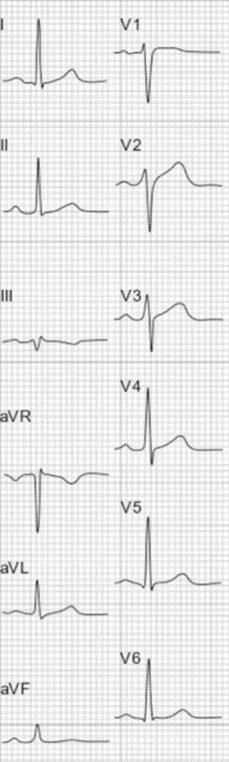 ECG patient without cardiac problems and one of patient with inferior wall MI and lateral wall ischemia.