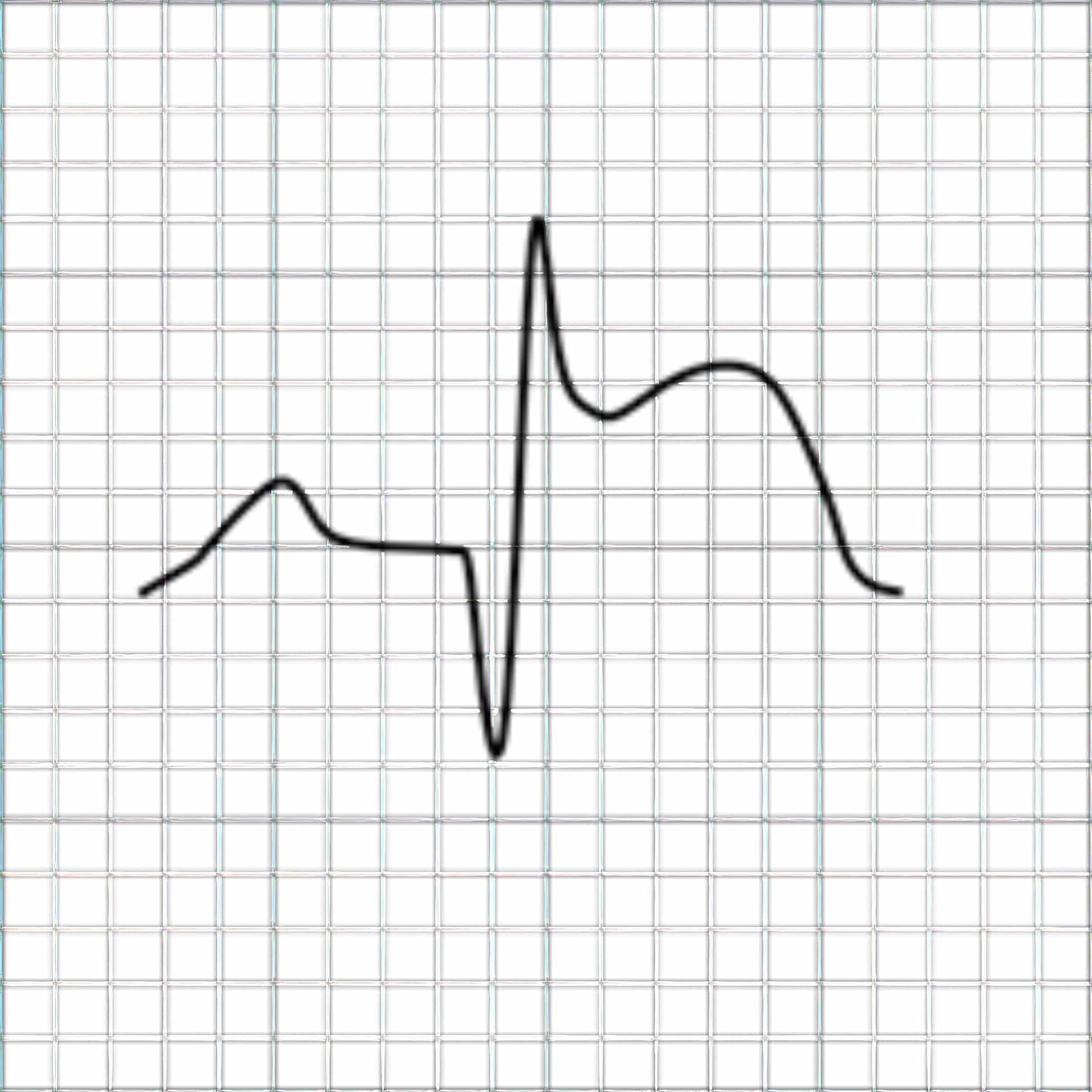 ECG depicting transmural lesion from MI.