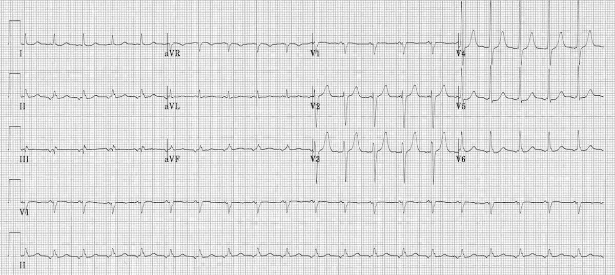 Ectopic atrial tachycardia ECG.
