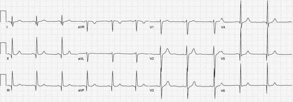 Hypertrophic cardiomyopathy ECG rhythms.