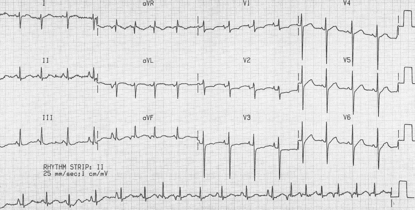 “Multifocal atrial tachycardia ECG.