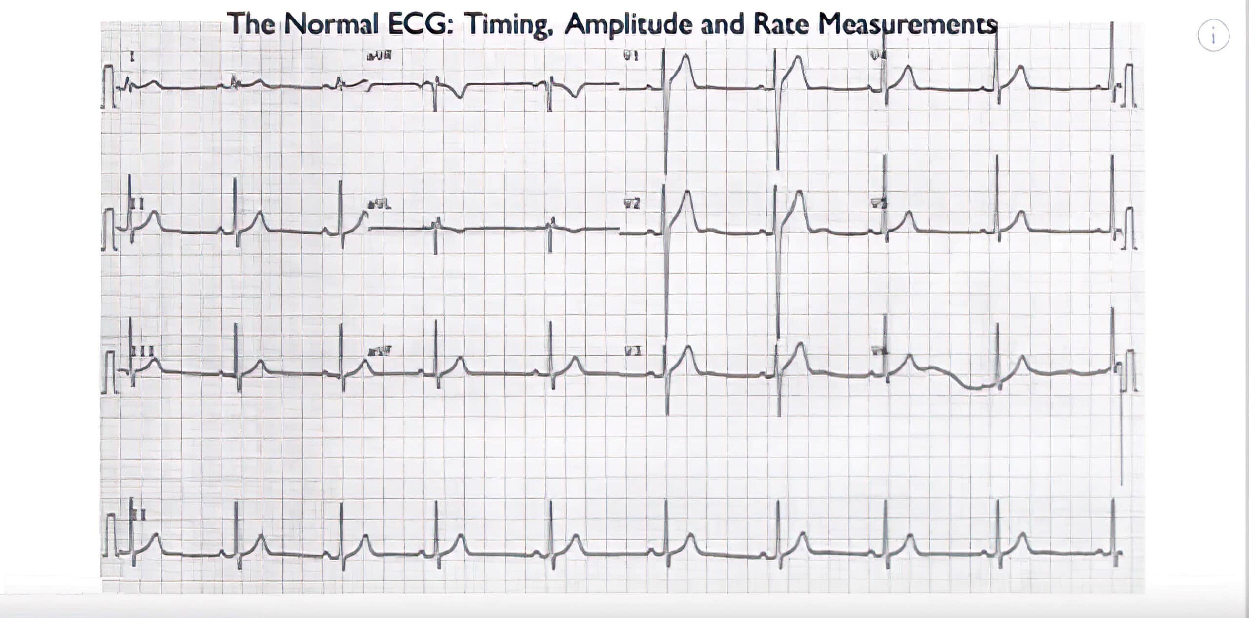 Normal ECG timing, amplitude, and rate.