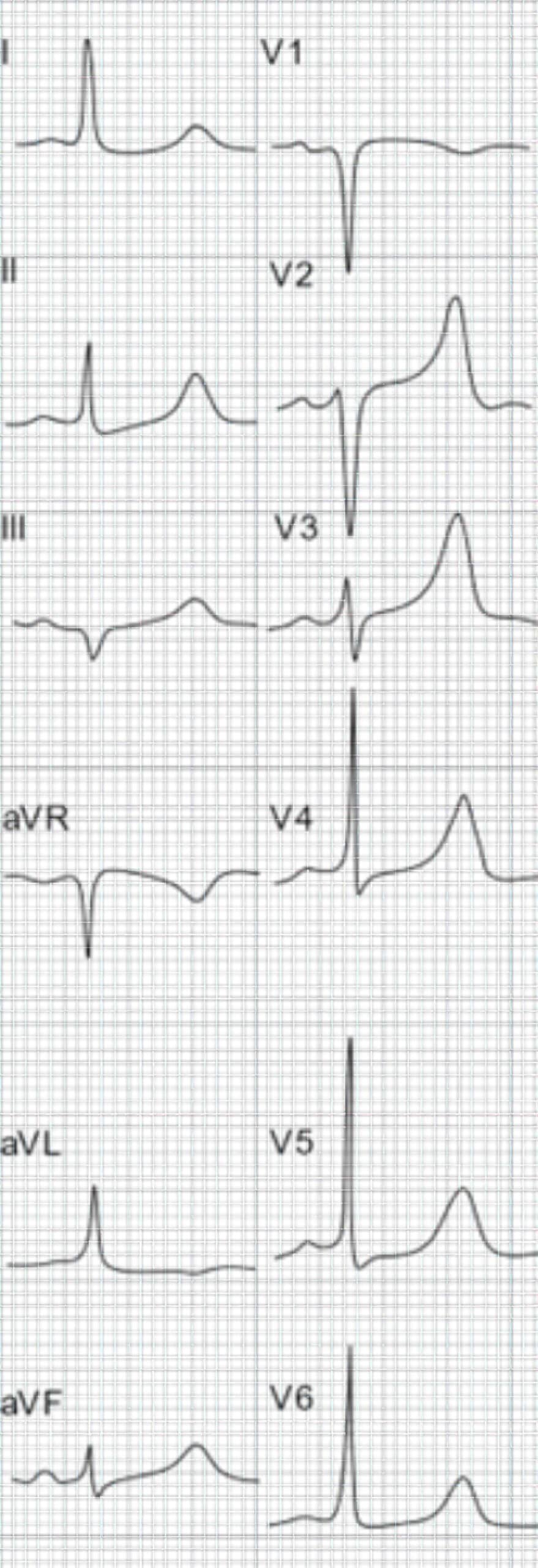 Patient with chronic renal failure, hyperkalemia, and hypocalcemia ECG.