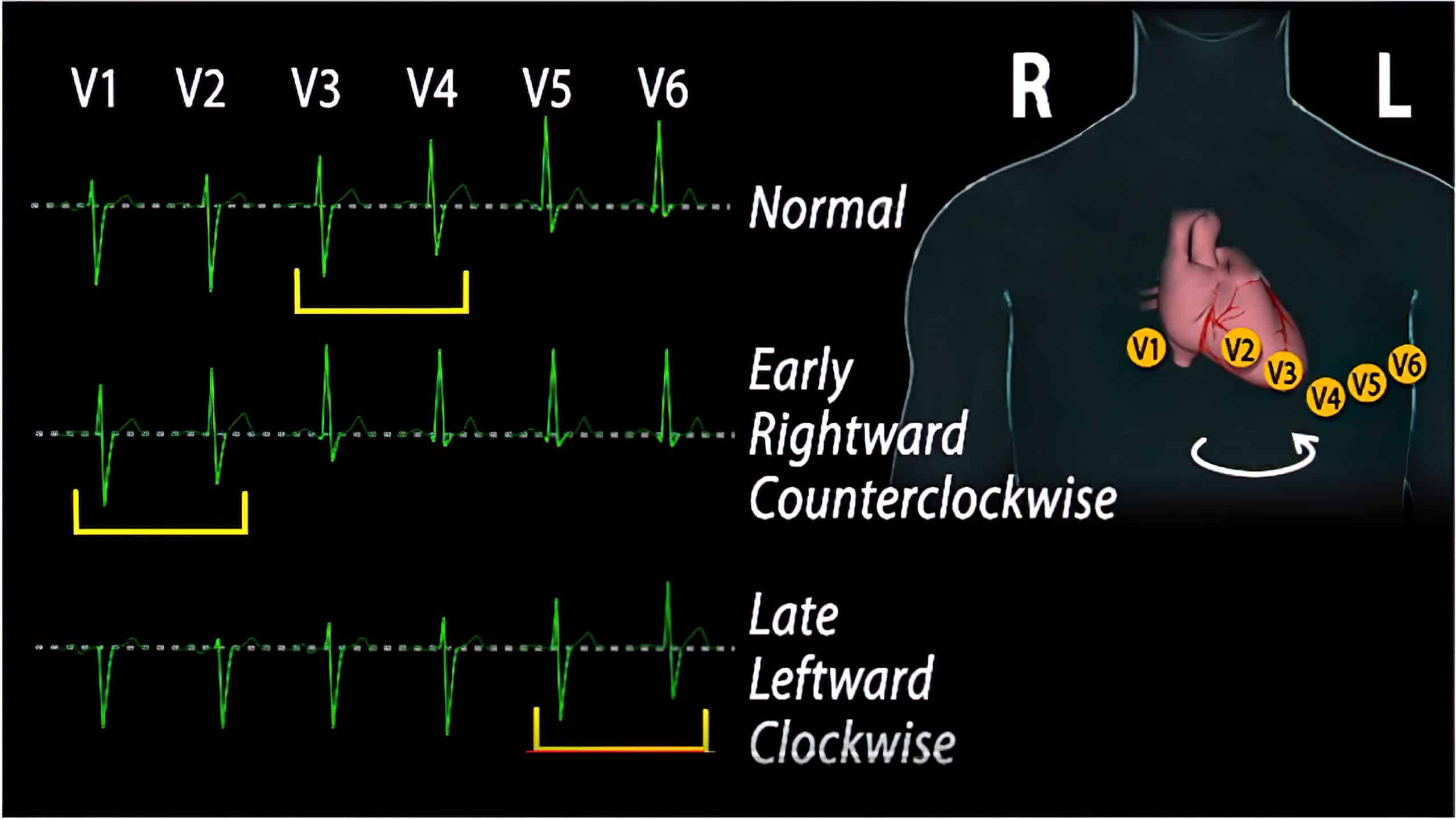 QRS variation video.