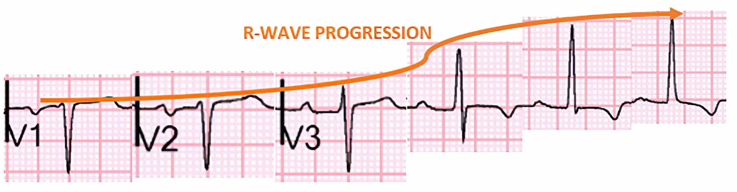 R-wave progression.