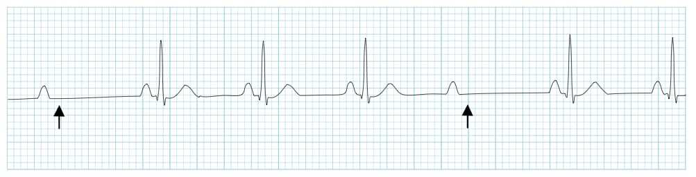Second-degree AV block, Mobitz type II ECG.