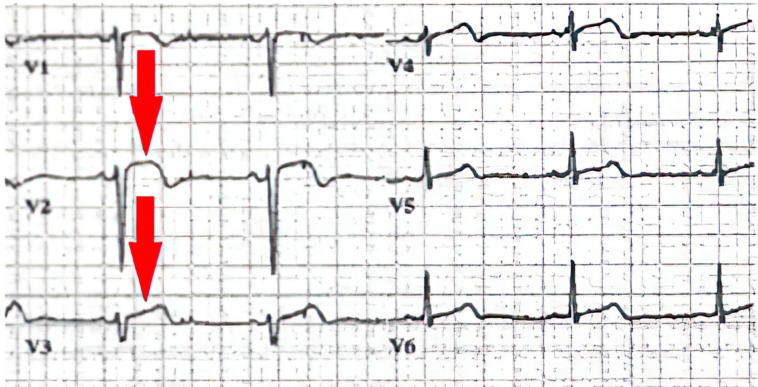 Sinus bradycardia with nonpathologic ST elevation.