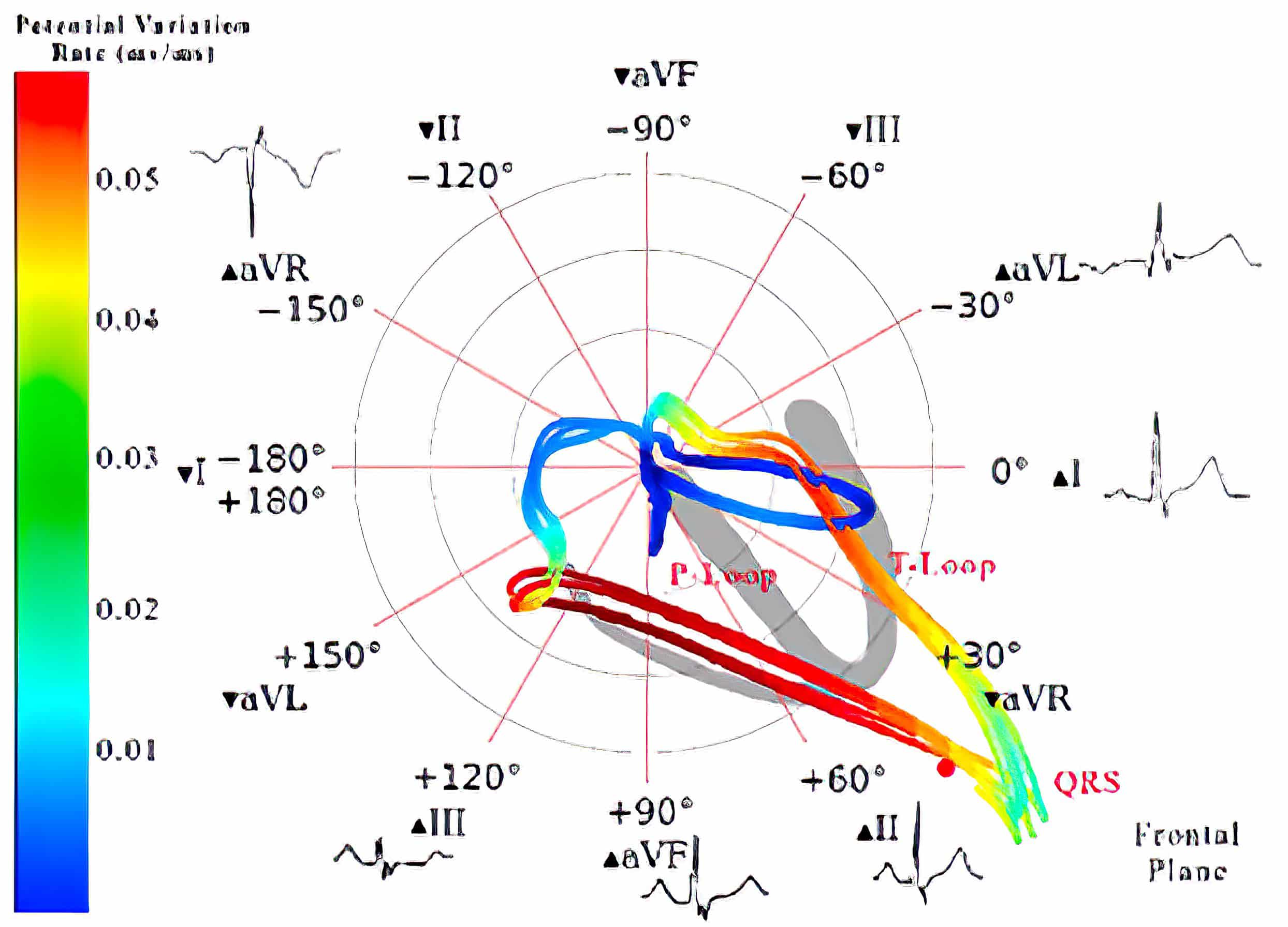 Vectorcardiograph (frontal plane) and electrocardiograph of complete RBBB and normal.