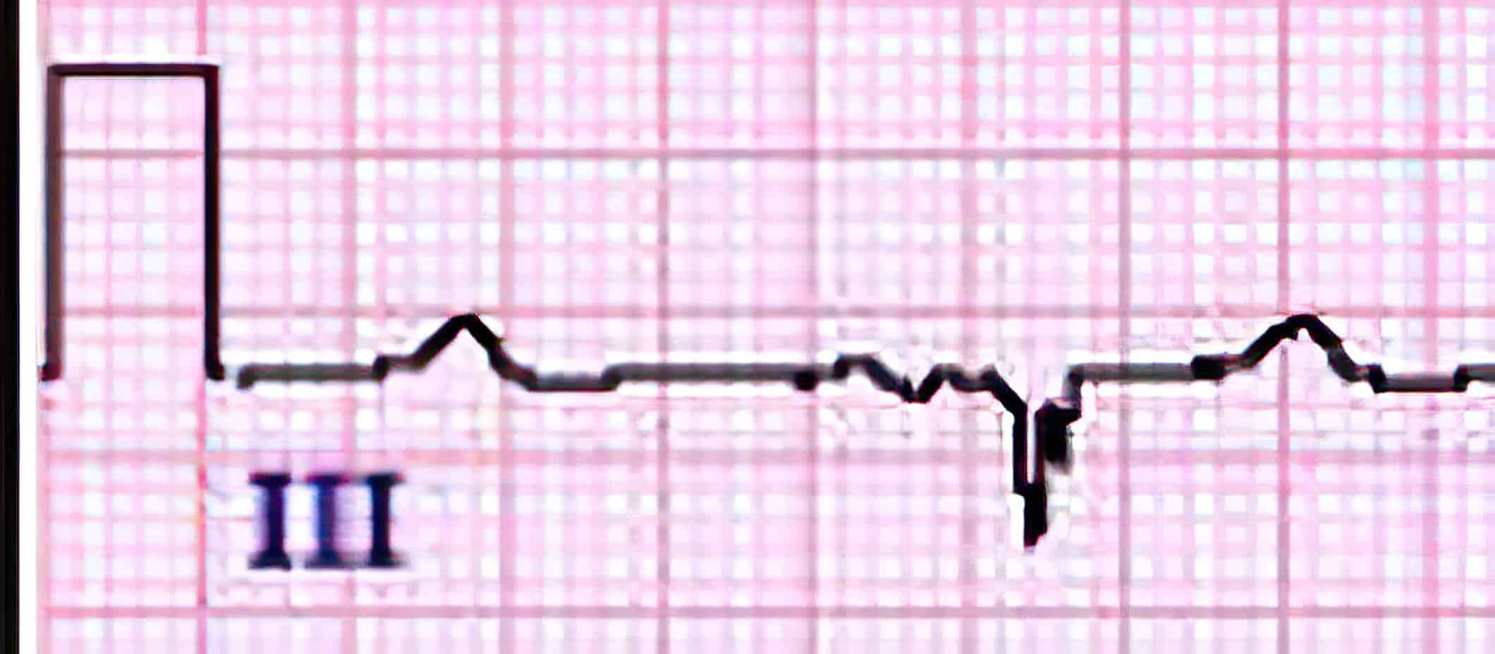 r-S-r’ complex notching.