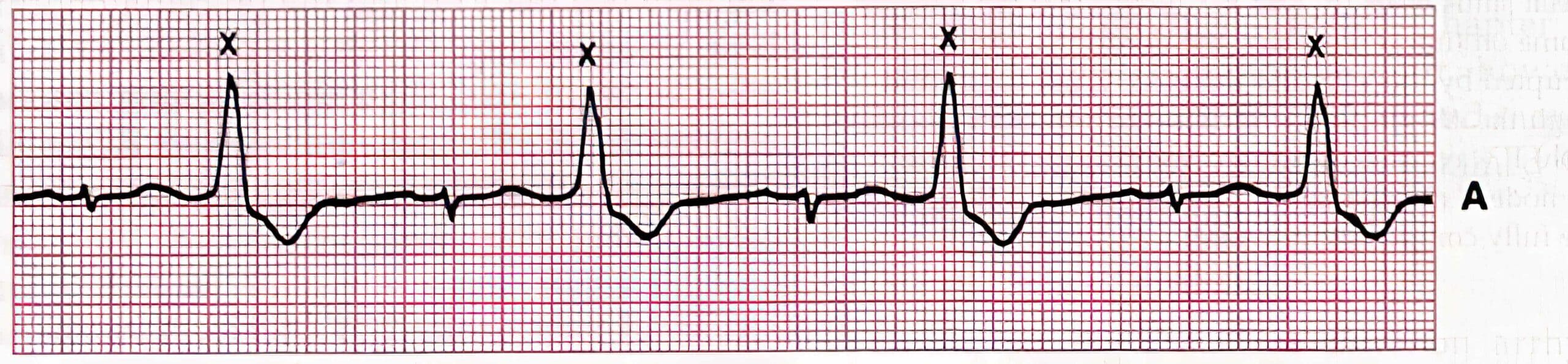 Bigeminy premature ventricular complex ECG.