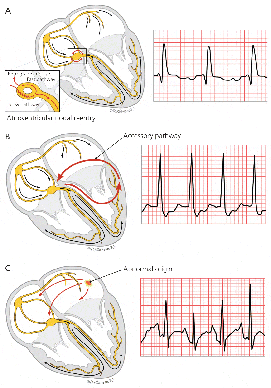 Different ECG reentry pathways.