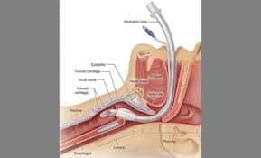 Esophageal-tracheal tube.