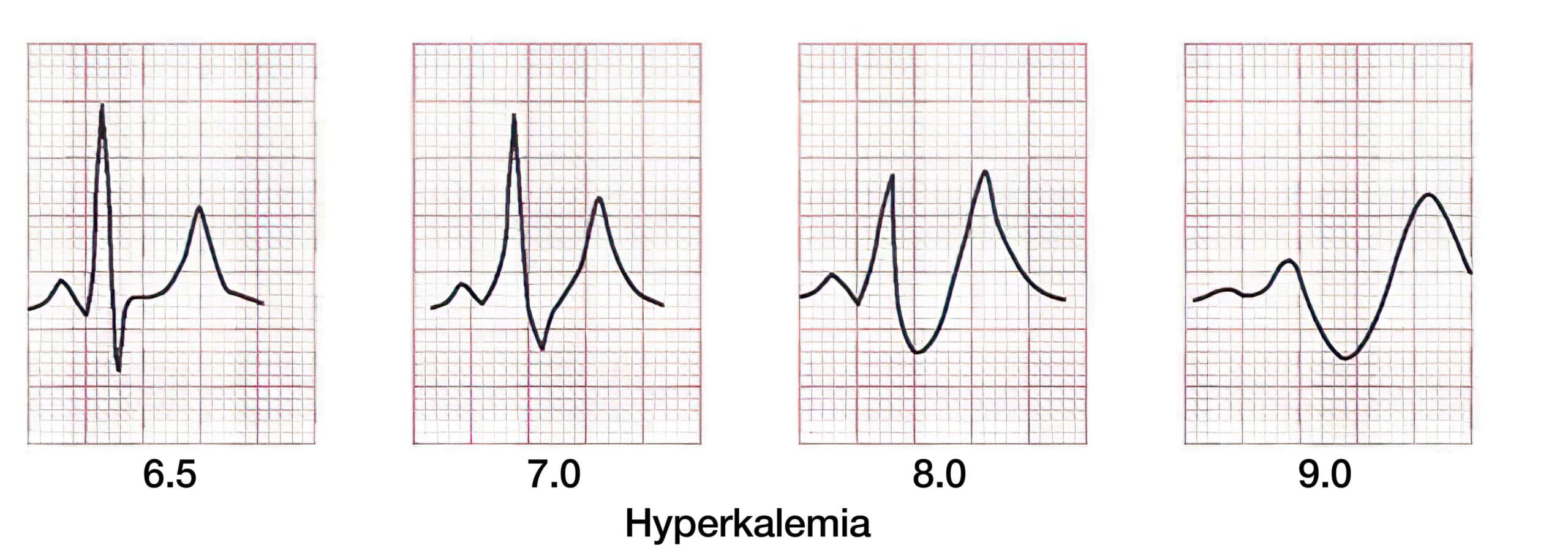 Hyperkalemia intervals ECG.
