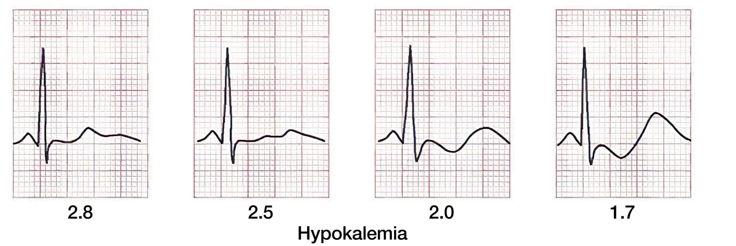 Hypokalemia ECG changes.