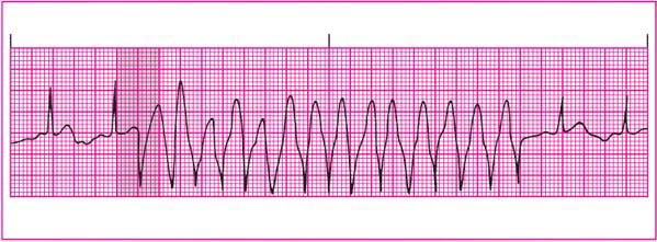 PVC with prolonged RR interval leading to V-tach or VF.
