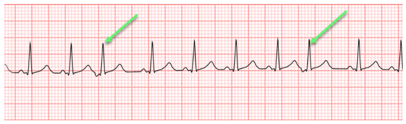 Premature Junction Complex ECG