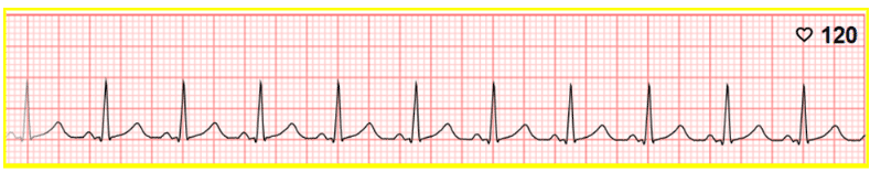 Sinus tachycardia with regular rate and rhythm ECG.