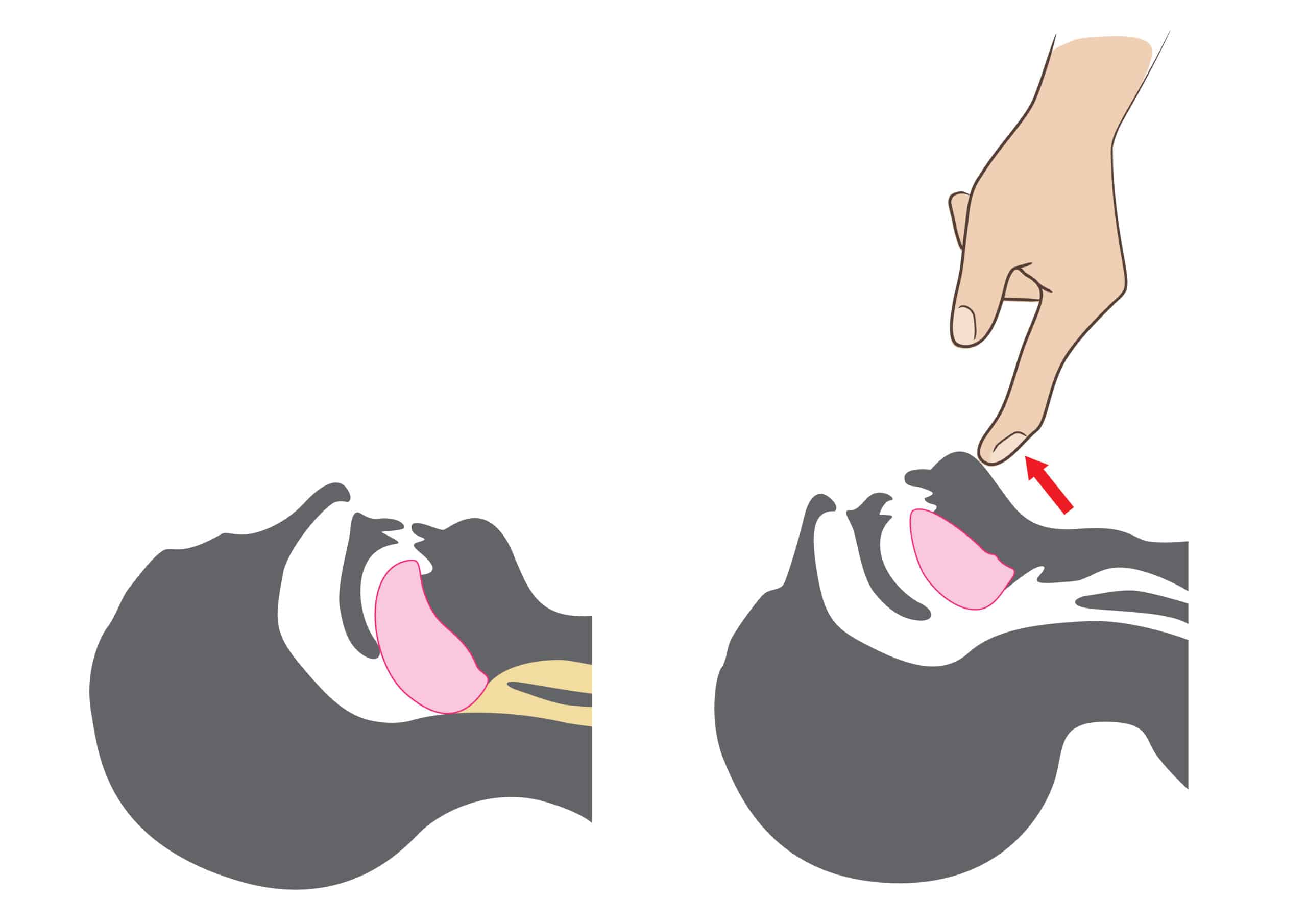 Tongue and epiglottis obstruction relieved by head tilt-chin lift and jaw thrust.