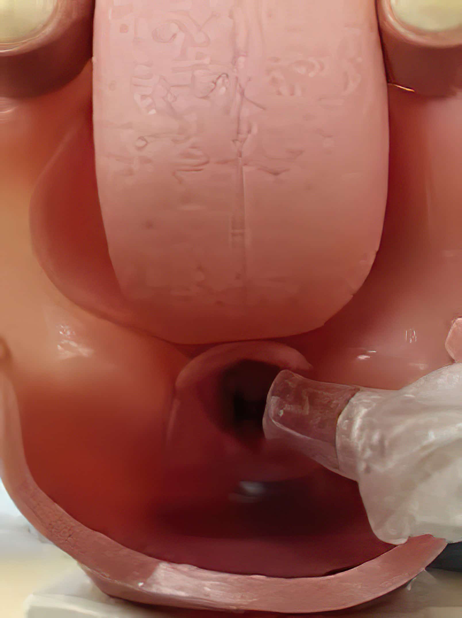 Vocal cords during ET tube placement; correct placement of ET tube.