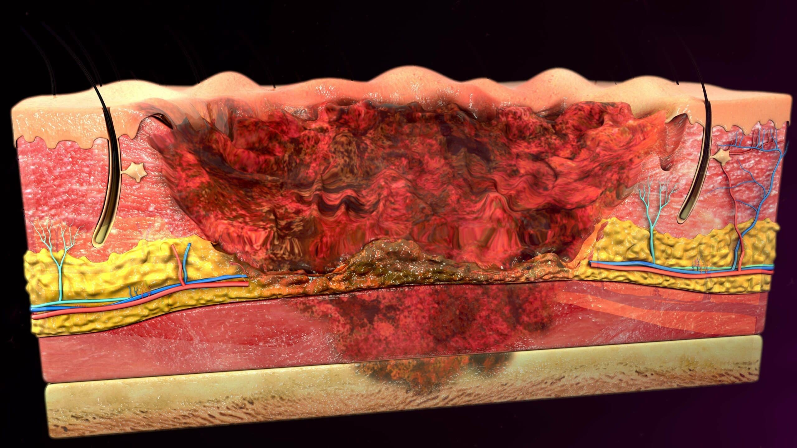 Full-thickness burn.