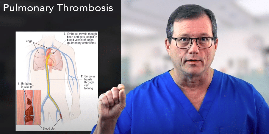 Hs & Ts – Pulmonary Thrombosis