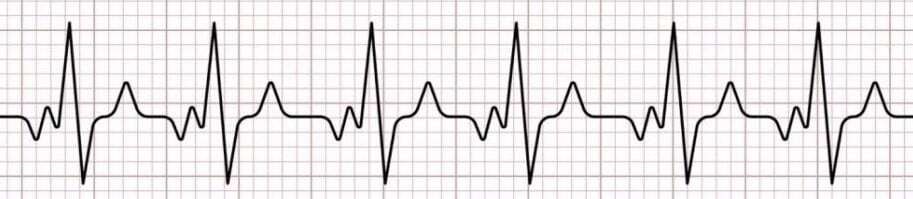 “ECG reading sinus tachycardia.”