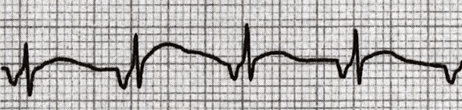 Junctional rhythm – ECG tracing.
