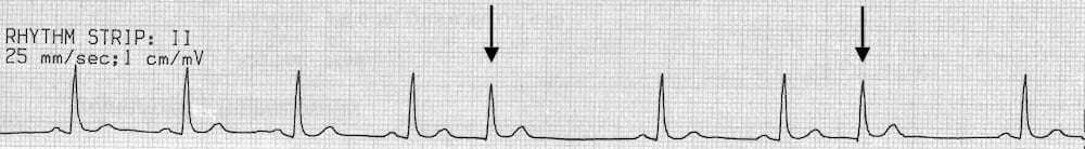 Premature junctional complexes – ECG tracing.