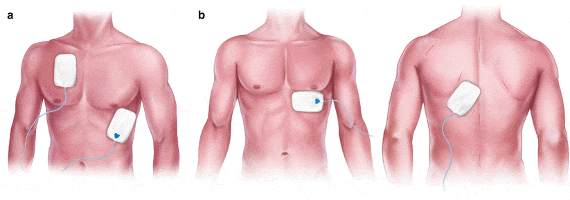 Transcutaneous pacing.