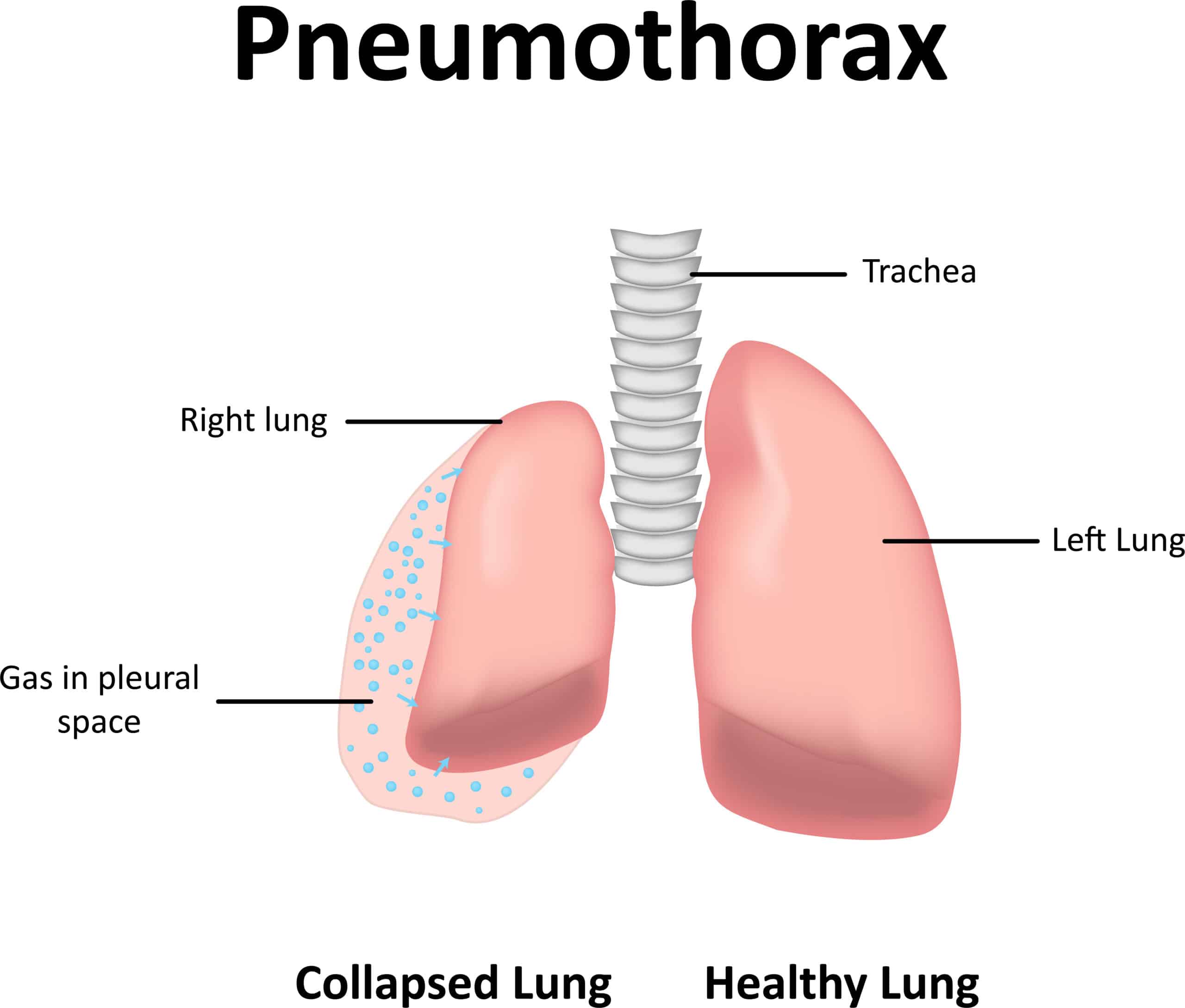 A diagram highlighting pneumothorax.