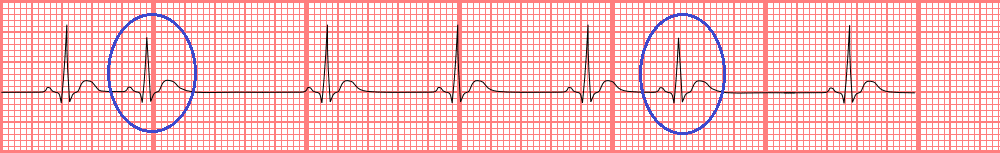 Premature atrial contraction.