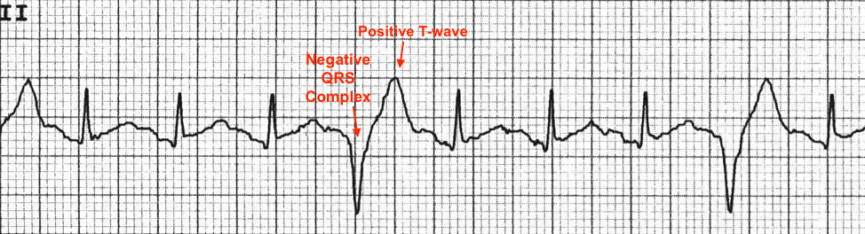 QRS complex with negative deflection followed by T wave with positive deflection.