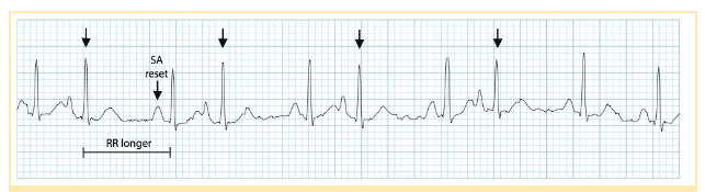 Frequent premature atrial complexes followed by brief pauses.
